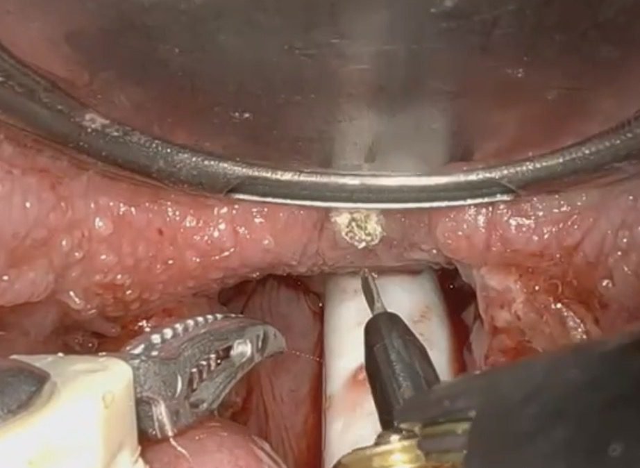 Robotic view of the tongue base